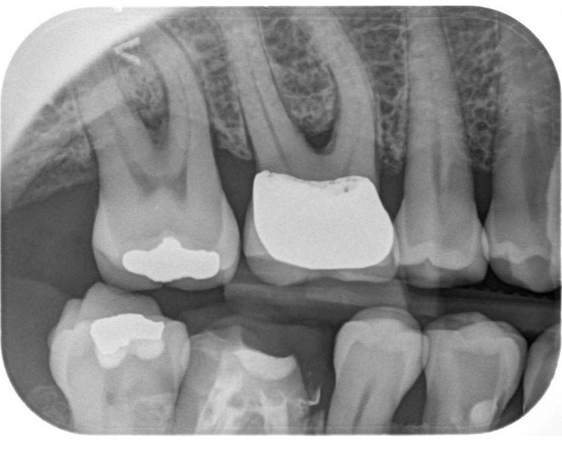 Fire CR Dental Phosphor Plate X-Ray System